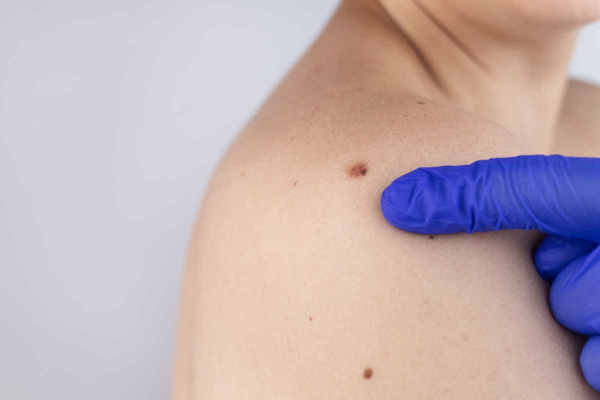 Come distinguere un neo da un melanoma