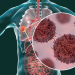 Perché il tumore ai polmoni vien e diagnosticato tardi