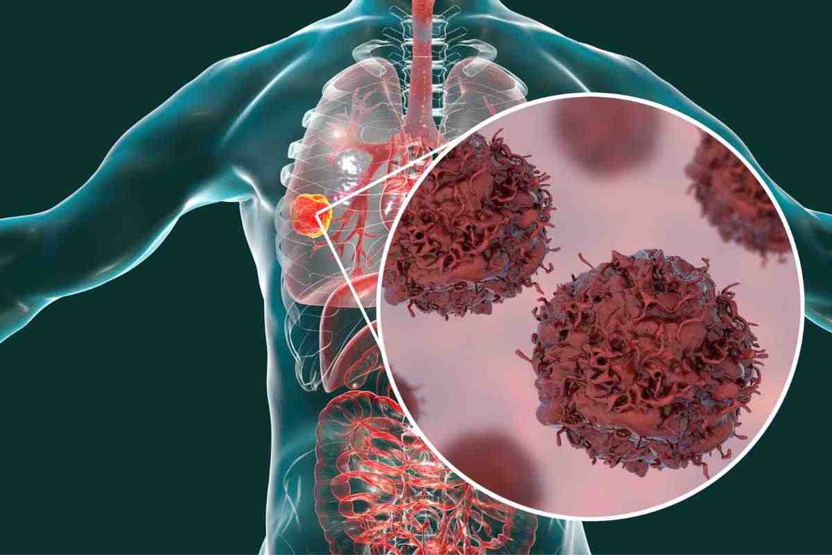 Perché il tumore ai polmoni vien e diagnosticato tardi